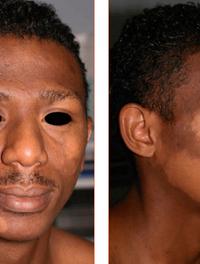 Figures 1 et 2. Macules hypopigmentées symétriques du visage