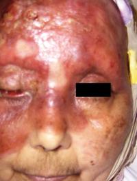 Figure 1. Patiente présentant une sarcoïdose à loca- lisation cutanée et ophtalmologique (vue de face).