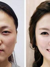 Une patiente chinoise avant (à gauche) et après un séjour chirurgical en Corée du Sud