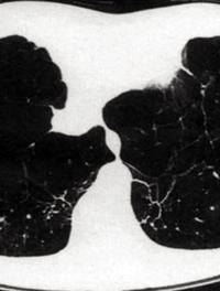 Figure 2.Scanner thoracique.