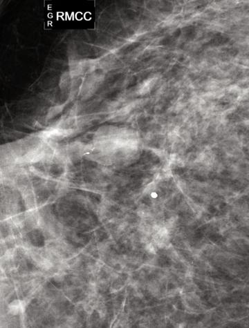 Figure 1. 52 ans, écoulement unipore spontané orange. Mammographie (compression localisée sur la région rétro- aréolaire) : masse centimétrique avec microcalcifications allongées. Papillome sclérosant.