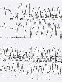 Figure 1. QT long et torsade de pointe.