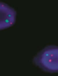 Figure 2.FISH sur noyaux interphasiques avec utili- sation de sondes spécifiques des chromosomes13 (vert) et 21 (rouge) montrant la présence de trois chromosomes 21