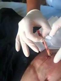 Extraction d'une balle