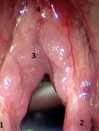 Figure 1. Laryngoscopie en suspension : papillomatose touchant les tiers moyen des deux cordes vocales. 1 :corde vocale gauche ; 2 :corde vocale droite ; 3 :lésion papillomateuse ; 4 : commissure antérieure.