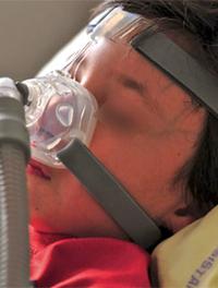 Figure 2. Garçon de 8 ans avec une paralysie laryngée congénitale qui a une trachéotomie depuis l’âge de 1 mois. La décanulation a été possible grâce à la PPC avec un masque nasal.
