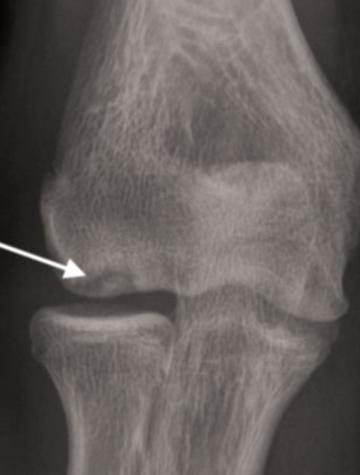 Figure 1. Ostéochondrose épiphysaire du condyle externe du coude.