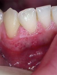 Figure 1. Érosion gingivale post-traumatique provoquée par un brossage dentaire