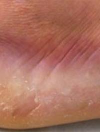 Figure 1. Hyperpigmentation linéaire et desquamation en lambeaux du bord latéro-externe du pied droit