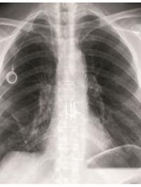 Trois mois après une transplantation pulmonaire.