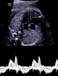 Figure 1.Exemple de mesure du TAV en mode Doppler pulsé 4 cavités en respectant les critères de qualité, score à 10.