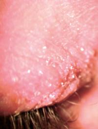 Eczéma lié à l’utilisation chronique d’antiallergique collyres conservés (allergie au conservateur).