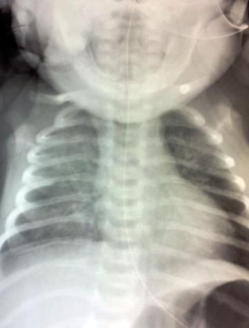 Radiographie de thorax effectuée à J16 de vie et retrouvant des opacités de l’hémichamp droit et du lobe supérieur gauche, en lien avec une pneumopathie d’inhalation multilobaire