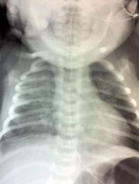 Radiographie de thorax effectuée à J16 de vie et retrouvant des opacités de l’hémichamp droit et du lobe supérieur gauche, en lien avec une pneumopathie d’inhalation multilobaire