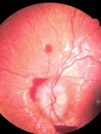 Figure 1. Rétinophotographie d’un enfant de victime d’un syndrome du bébé secoué. Cette photographie de fond d’œil (œil gauche) fait apparaître un œdème papillaire reflétant une hypertension intracrânienne associée et des hémorragies sous- et susrétiniennes