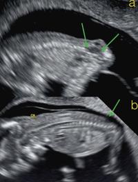 Spina-bifida ouverts