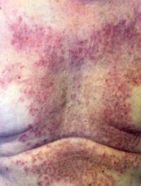 Figure 1. Lésions médiothoraciques étendues, réticulées.