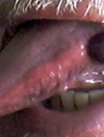 Figure 1. Bulle hémorragique.