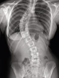 Figure 1. Scoliose thoracique. Déséquilibre latéral. Radiographie préopératoire du rachis de face