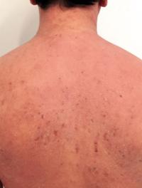 Peau sèche avec lichénification et lésions de grattage du dos chez un jeune adulte atopique.