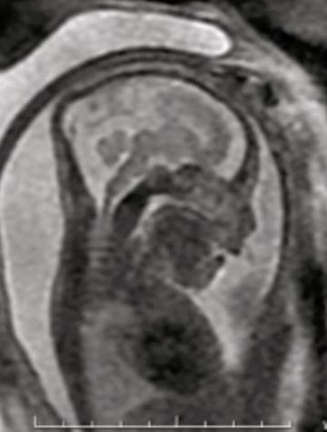 Figure 1. IRM de cerveau fœtal, coupe sagittale en T2 : front court et absence de voûte crânienne ; diminution du volume cérébral, élargissement des espaces péri-cérébraux et ventriculomégalie ; atrophie corticale du vermis et du tronc. 