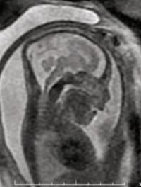 Figure 1. IRM de cerveau fœtal, coupe sagittale en T2 : front court et absence de voûte crânienne ; diminution du volume cérébral, élargissement des espaces péri-cérébraux et ventriculomégalie ; atrophie corticale du vermis et du tronc. 