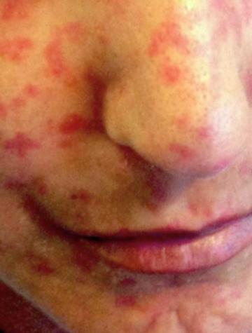 Figure 1. Nombreuses télangiectasies faciales