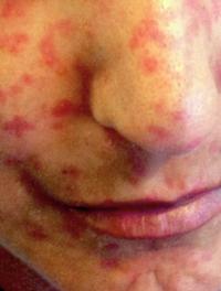 Figure 1. Nombreuses télangiectasies faciales