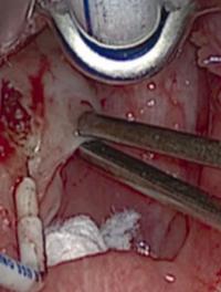Visualisation per-opératoire. Amygdalectomie intracapsulaire