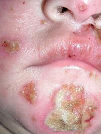 Impetigo