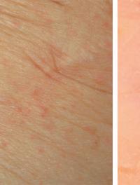 Figure 1. Aspect clinique (gauche) et dermatoscopique (droite, grossissement 20 x) d’une gale. La dermatoscopie montre le signe du deltaplane (flèche jaune). Le triangle du deltaplane correspond à l’extrémité céphalique du parasite et est suivi par le sillon (flèche bleue).