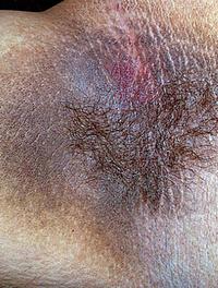 Figure 1. Acanthosis nigricans. 
